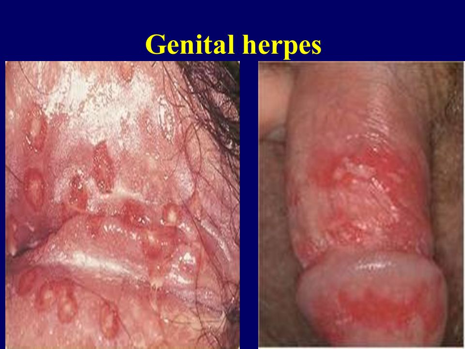Herpes spread oral sex